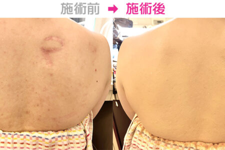 カバーメイク　傷跡とシミとニキビ跡